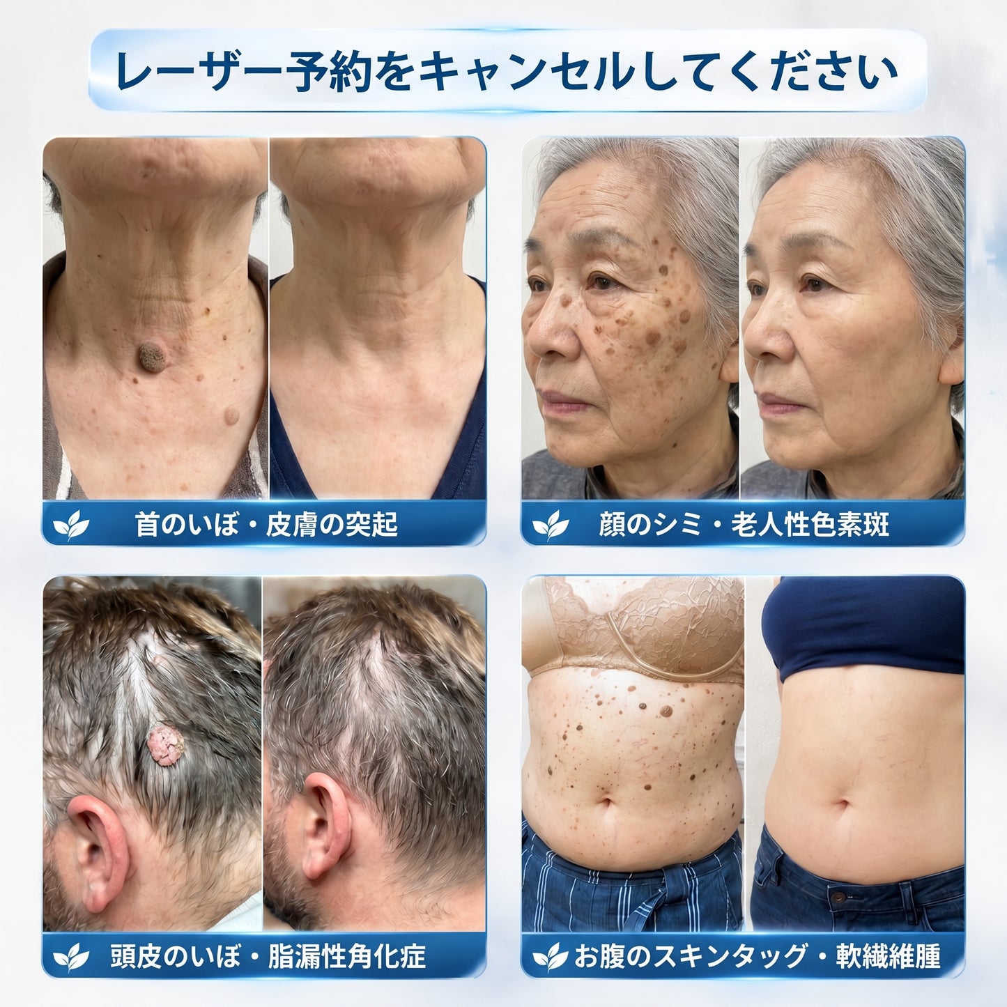 𝐏i𝐜𝐝o® 7日間 タグ＆スポットイレーサー（痛みゼロ・傷跡ゼロ ローラーボールタイプ）💪