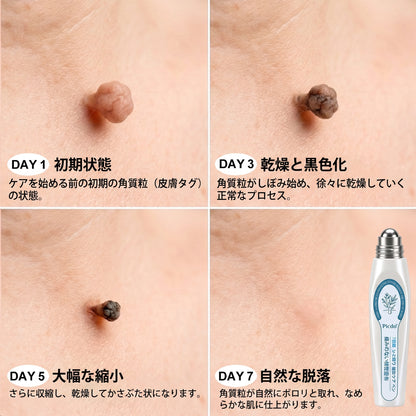 𝐏i𝐜𝐝o® 7日間 タグ＆スポットイレーサー（痛みゼロ・傷跡ゼロ ローラーボールタイプ）💪