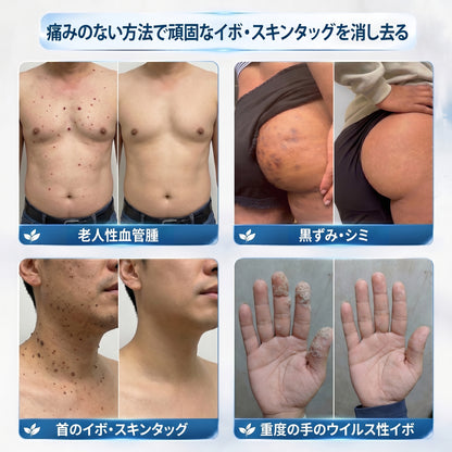 𝐏i𝐜𝐝o® 7日間 タグ＆スポットイレーサー（痛みゼロ・傷跡ゼロ ローラーボールタイプ）💪